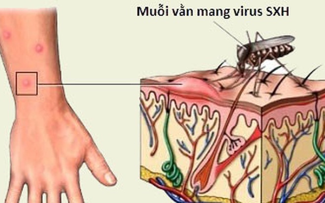 Sốt xuất huyết - hãy coi chừng vì chúng có thể giết chết bạn trong 24 giờ - Ảnh 2.