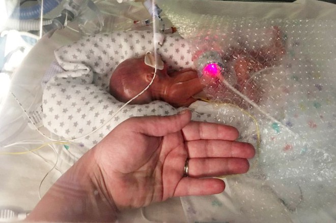 Em bé hạt tiêu nặng 0,5kg chỉ nhỉnh hơn bàn tay người lớn - Ảnh 1.