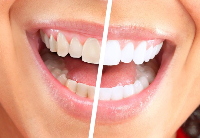 Đây là những lý do khiến bạn phải ngừng ngay thói quen sử dụng tăm để xỉa răng - Ảnh 1.