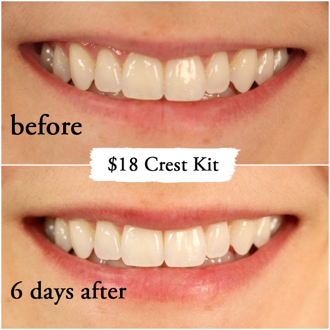 Thử làm trắng răng với 2 sản phẩm đắt và rẻ tiền, 2 cô nàng này đã nhận được kết quả thú vị - Ảnh 9.