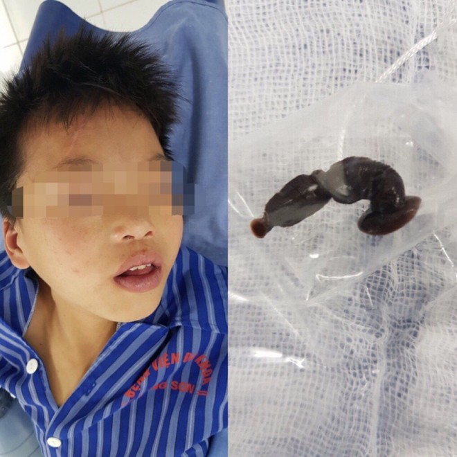 Bác sĩ gắp con đỉa dài 6cm trong cổ họng bệnh nhi 13 tuổi - Ảnh 1.