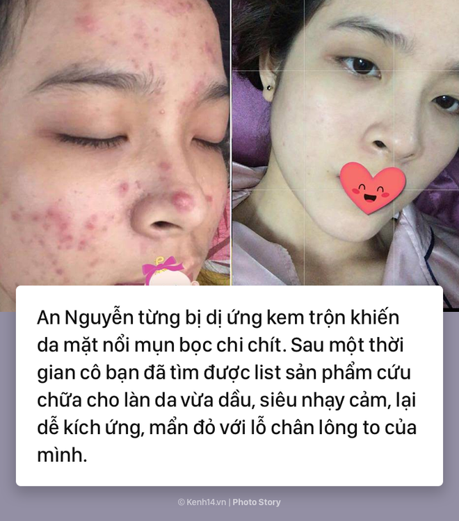 Dùng kem trộn bị dị ứng, cô bạn này cứu vãn làn da của mình thế nào? - Ảnh 1.