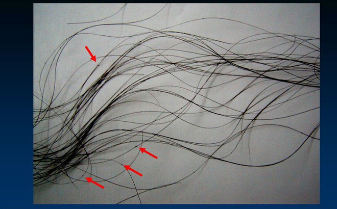 Từ thói quen nhiều bạn gái hay mắc phải đến căn bệnh trứng tóc không thể coi thường - Ảnh 2.