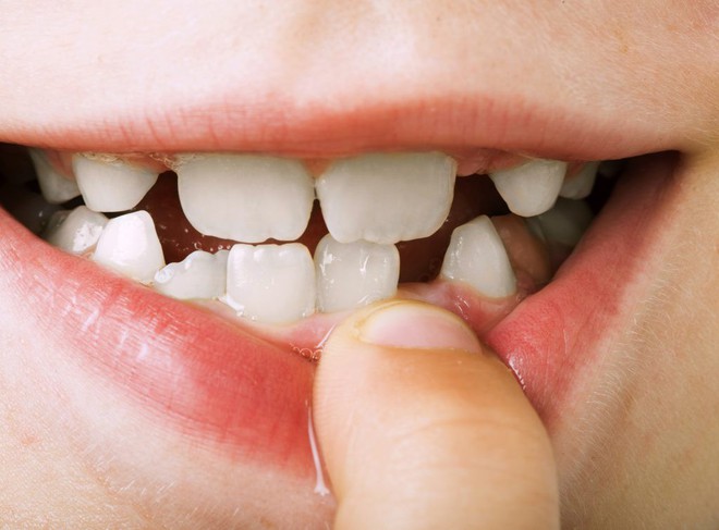 Cẩn thận mắc bệnh viêm nướu răng nếu gặp phải 5 dấu hiệu sau - Ảnh 4.