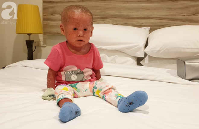 H&igrave;nh ảnh mới nhất của b&eacute; B&iacute;ch bị bỏ rơi, người đầy vẩy ngứa như da trăn sau đợt kh&aacute;m bệnh đầu ti&ecirc;n tại Singapore - Ảnh 4.
