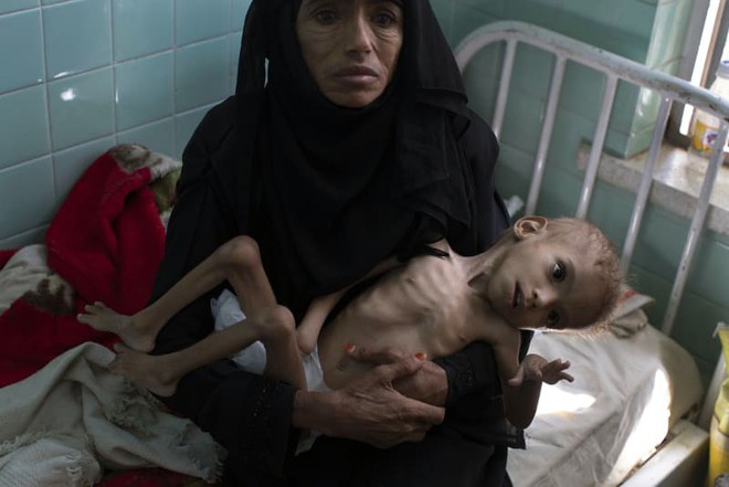 Bé gái trong bức ảnh gây chấn động thế giới về nạn đói đã qua đời, trở thành biểu tượng đau đớn của cuộc khủng hoảng tại Yemen - Ảnh 2.