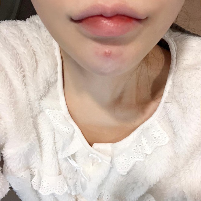 C&aacute;ch trị mụn: Review 5 sản phẩm trị mụn thần tốc ai cũng cần biết - Ảnh 8.