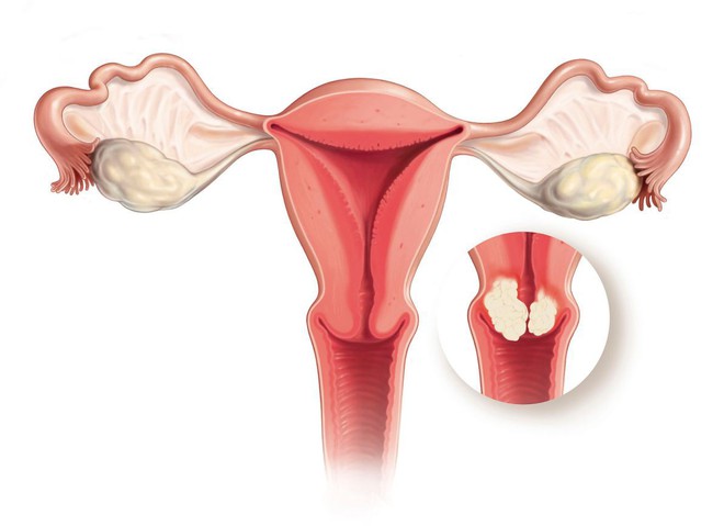 6 vấn đề cần quan tâm nhất của ung thư cổ tử cung mà bạn nữ nào cũng cần biết - Ảnh 2.