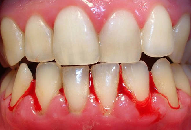 Thấy răng miệng có những dấu hiệu bất thường này thì chớ có chủ quan - Ảnh 1.