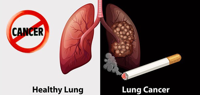 Căn bệnh khiến hơn 20.000 người Việt tử vong mỗi năm và đây là cách bạn phòng chống nó - Ảnh 2.