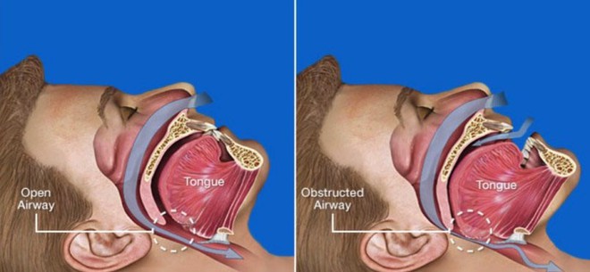 Sáng ngủ dậy hay thấy có triệu chứng đau đầu thì nên tìm hiểu xem nguyên nhân là do đâu? - Ảnh 3.