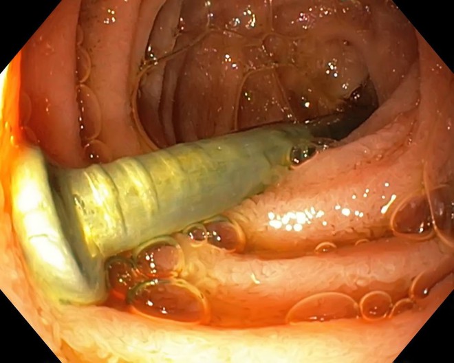 B&eacute; trai gần 2 tuổi su&yacute;t thiệt mạng v&igrave; nuốt phải c&acirc;y đinh d&agrave;i khoảng 3cm - Ảnh 3.