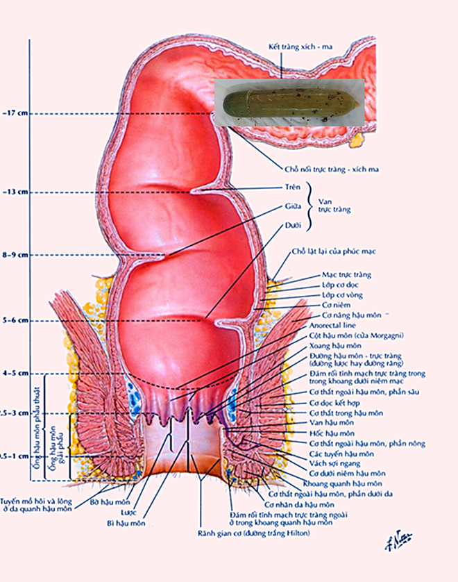 Nam bệnh nhân bị lọt cả quả dưa leo vào bụng - Ảnh 1.