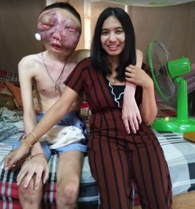 D&ugrave; chồng bị ung thư với khu&ocirc;n mặt biến dạng, vợ vẫn một l&ograve;ng ở b&ecirc;n chăm s&oacute;c: 3 năm, em vẫn y&ecirc;u anh như ng&agrave;y đầu - Ảnh 3.