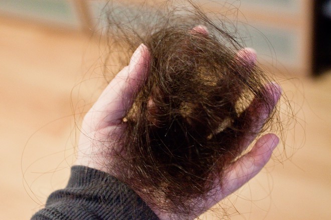 Bắt bệnh qua 5 dấu hiệu bất thường rất dễ nhận biết ngay trên mái tóc của bạn - Ảnh 3.