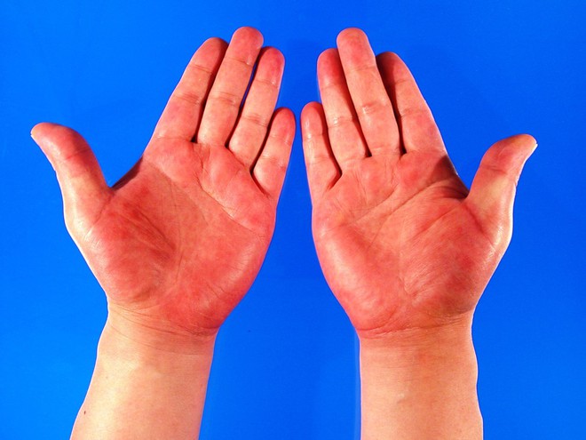 Nhìn màu sắc lòng bàn tay để nhận biết tình trạng sức khoẻ hiện tại của bạn - Ảnh 1.