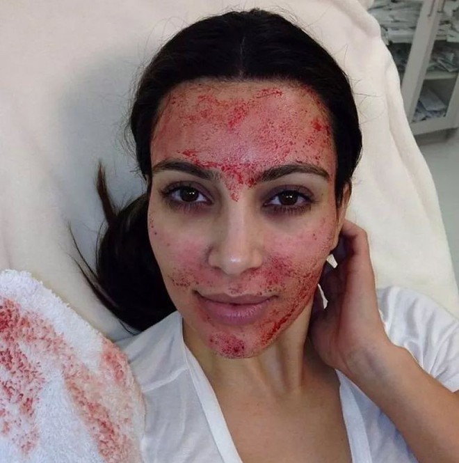 Bất chấp như Kim Kardashian cũng phải cạch đến gi&agrave; sau khi &aacute;p dụng liệu ph&aacute;p l&agrave;m đẹp gh&ecirc; rợn n&agrave;y - Ảnh 2.
