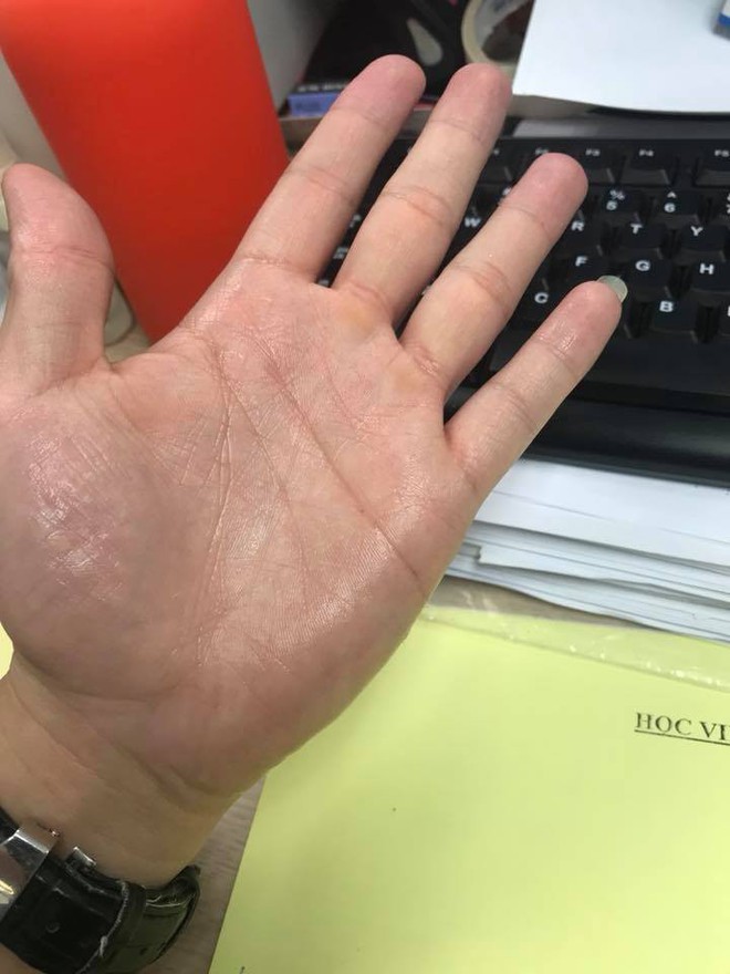 Nỗi khổ của những thanh ni&ecirc;n c&oacute; b&agrave;n tay ướt nhẹp quanh năm - Ảnh 4.