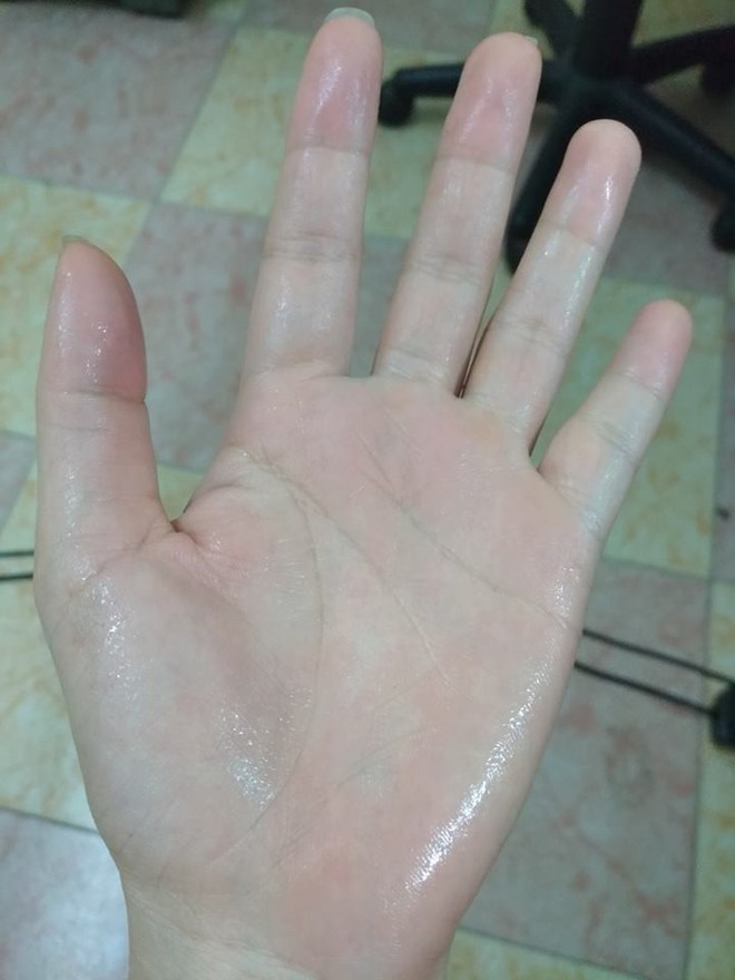 Nỗi khổ của những thanh ni&ecirc;n c&oacute; b&agrave;n tay ướt nhẹp quanh năm - Ảnh 2.