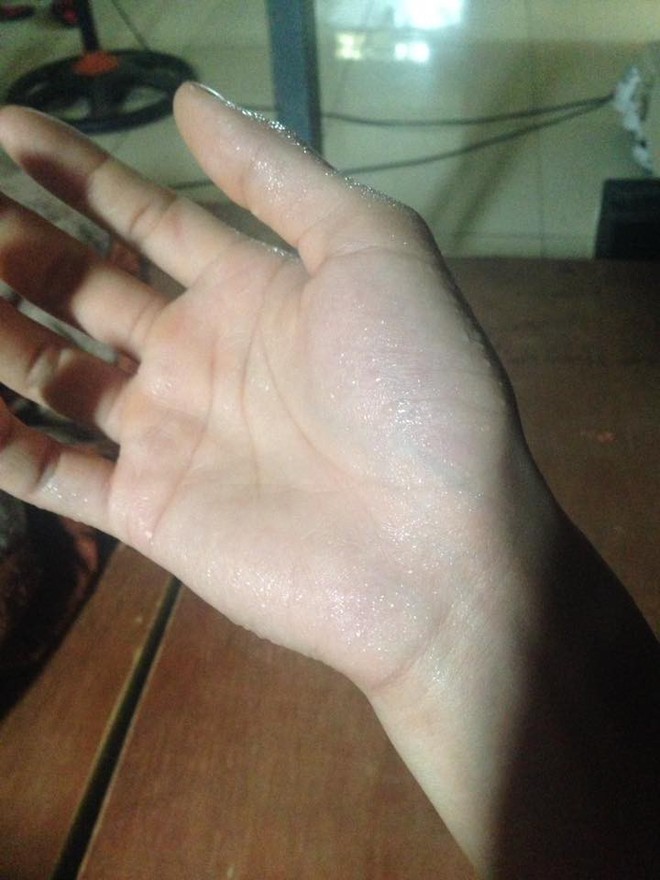 Nỗi khổ của những thanh ni&ecirc;n c&oacute; b&agrave;n tay ướt nhẹp quanh năm - Ảnh 1.