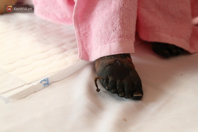 X&oacute;t xa b&eacute; g&aacute;i 3 tuổi phải phẫu thuật th&aacute;o khớp tứ chi sau cơn sốt nhiễm khuẩn huyết - Ảnh 2.