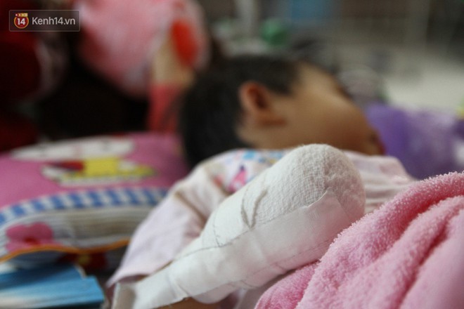 Xót xa bé gái 3 tuổi phải phẫu thuật tháo khớp tứ chi sau cơn sốt nhiễm khuẩn huyết - Ảnh 1.