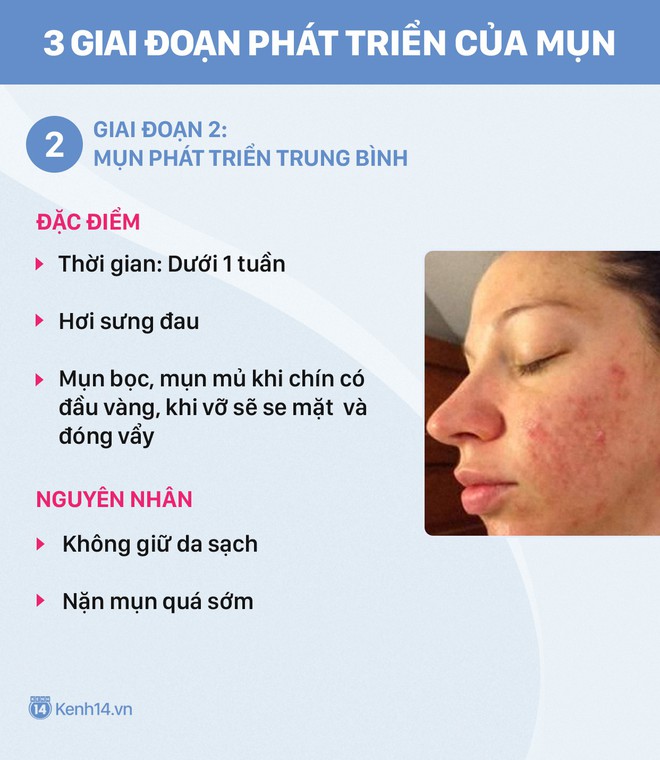 Muốn chữa mụn trứng cá hiệu quả cũng phải biết cách trị theo đúng giai đoạn - Ảnh 3.