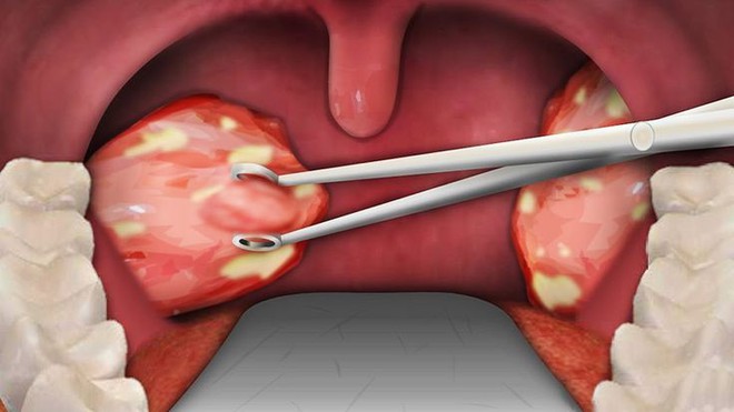 Hơi thở có mùi là dấu hiệu cảnh báo vấn đề sức khỏe gì? - Ảnh 5.