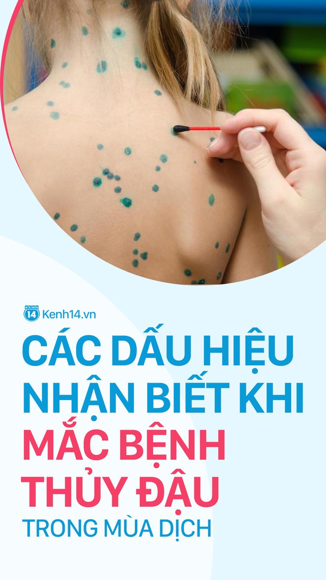 Mùa này rất dễ bị thủy đậu, cẩn thận khi gặp những dấu hiệu bệnh dưới đây - Ảnh 2.