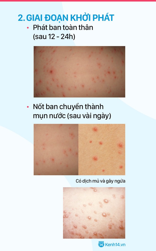 Mùa này rất dễ bị thủy đậu, cẩn thận khi gặp những dấu hiệu bệnh dưới đây - Ảnh 4.