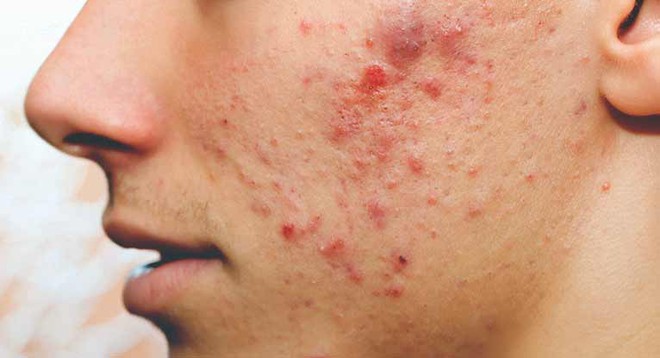 Mọc mụn trứng c&aacute; ở m&aacute; l&agrave; biểu hiện cho thấy cơ thể đang gặp vấn đề g&igrave;? - Ảnh 1.