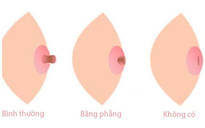 Thấy c&oacute; những dấu hiệu n&agrave;y tr&ecirc;n ngực th&igrave; hội con g&aacute;i chớ chủ quan m&agrave; cần đi kh&aacute;m ngay - Ảnh 4.