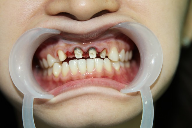 Bọc răng sứ không đảm bảo chất lượng, bạn phải đối mặt với những nguy cơ không ngờ - Ảnh 4.