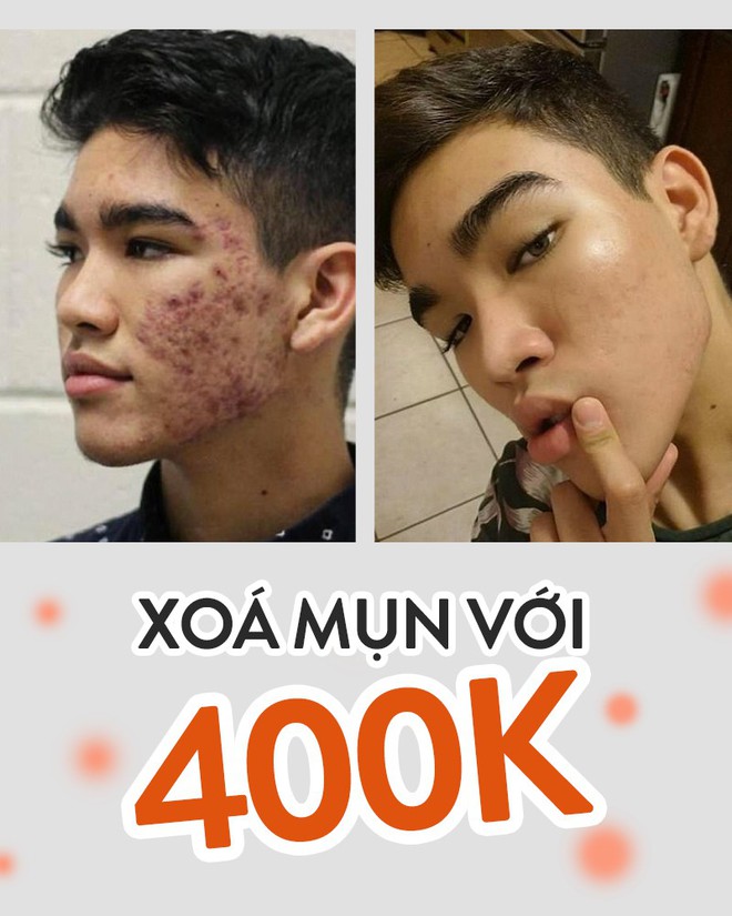 List sản phẩm c&oacute; gi&aacute; chỉ 4-500k gi&uacute;p anh ch&agrave;ng n&agrave;y tho&aacute;t khỏi t&igrave;nh trạng da mụn nghi&ecirc;m trọng - Ảnh 1.