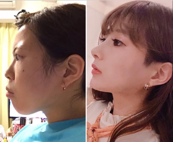 Khoe ảnh PTTM th&agrave;nh c&ocirc;ng, thiếu nữ Nhật được d&acirc;n t&igrave;nh nhận x&eacute;t: Tr&ocirc;ng như vừa đầu thai kiếp kh&aacute;c! - Ảnh 4.