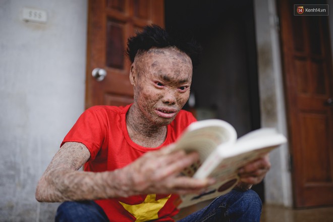 Chàng trai người cá lạc quan ở Hà Nội: Nhìn thấy bộ dạng của mình, nhiều người hỏi sao không chết đi, sống để làm gì? - Ảnh 11.