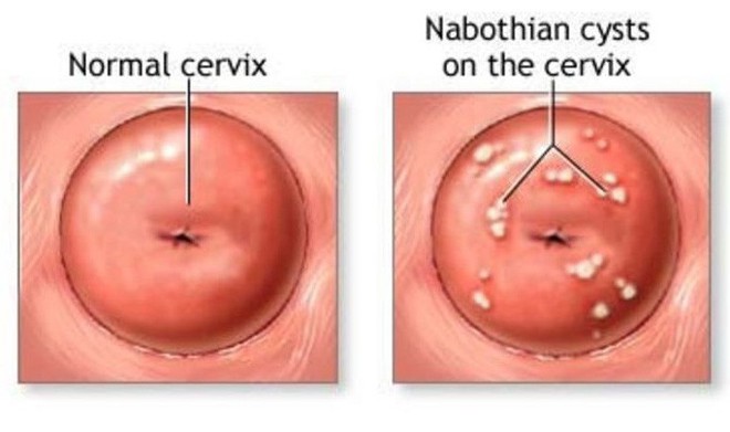 5 bệnh thường gặp ở cổ tử cung mà con gái không nên chủ quan bỏ qua - Ảnh 2.