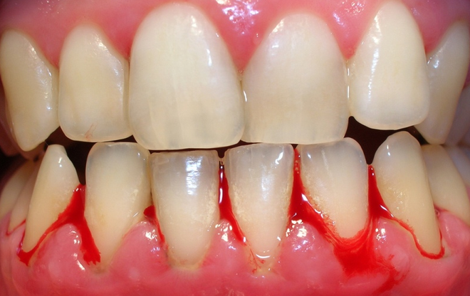 6 dấu hiệu cảnh báo hàm răng của bạn bắt đầu bị lão hóa - Ảnh 2.
