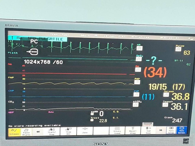 Một trái tim nằm ngoài lồng ngực bay từ Hà Nội vào Huế để cứu mạng bệnh nhân trẻ tuổi - Ảnh 2.