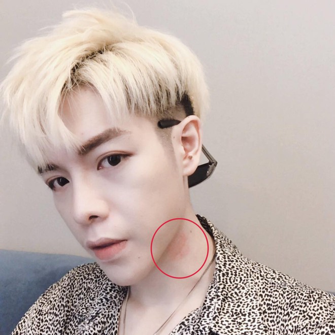 Bị dấu đỏ bất thường nghi l&agrave; vết t&iacute;ch của người y&ecirc;u tr&ecirc;n cổ, Đức Ph&uacute;c kh&oacute;c dở mếu dở giải th&iacute;ch với fan - Ảnh 1.