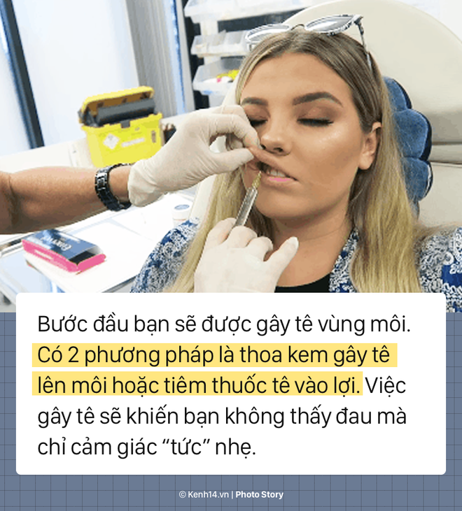 Quy trình tiêm filler để có một đôi môi tều chuẩn sexy - Ảnh 3.