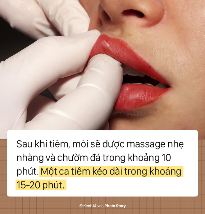 Quy trình tiêm filler để có một đôi môi tều chuẩn sexy - Ảnh 7.