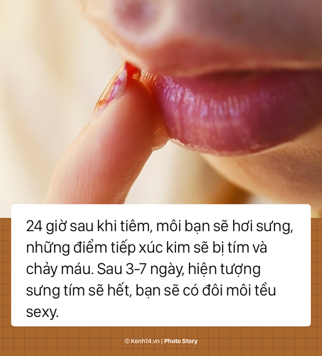 Quy trình tiêm filler để có một đôi môi tều chuẩn sexy - Ảnh 9.