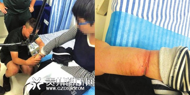 Tự đeo c&ograve;ng suốt 1 năm rồi mặc &aacute;o d&agrave;i tay để giấu gia đ&igrave;nh, cậu b&eacute; 14 tuổi bị chấn thương nghi&ecirc;m trọng tới biến dạng c&aacute;nh tay - Ảnh 1.