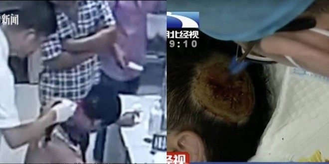 Trung Quốc: Đặt pin dự ph&ograve;ng dưới gối khi ngủ, pin bất ngờ ph&aacute;t nổ khiến người đ&agrave;n &ocirc;ng bị ch&aacute;y đen thui một mảng đầu - Ảnh 1.