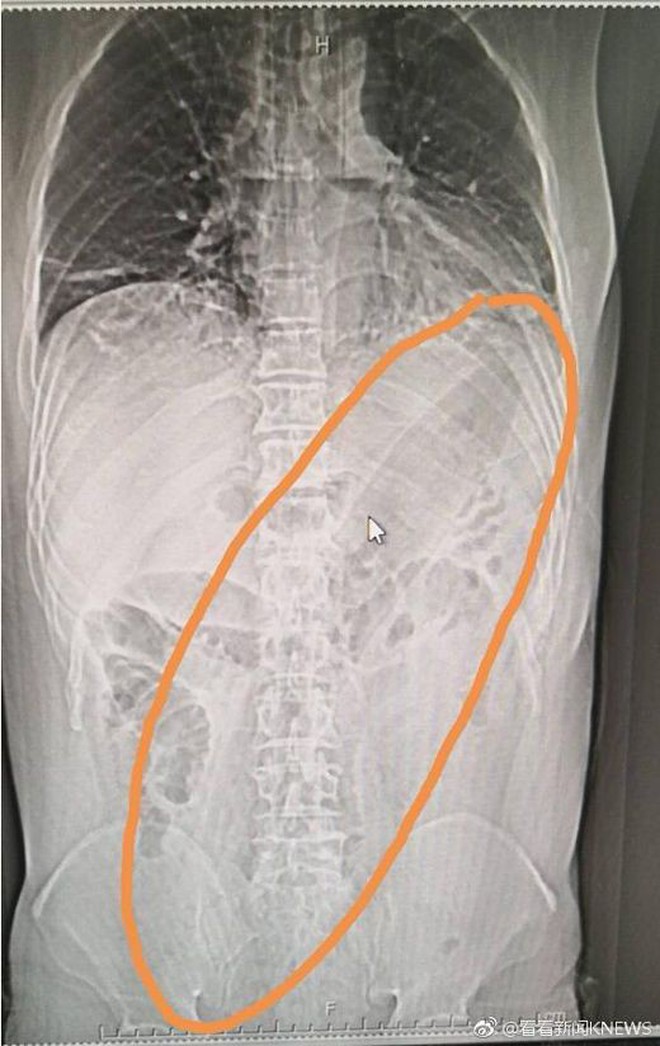 Trung Quốc: Tới bệnh viện với quả cà tím trong trực tràng, người đàn ông khai "để chữa táo bón theo mẹo dân gian" - Ảnh 1.