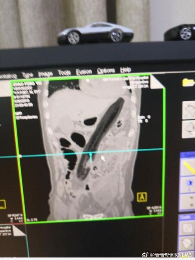 Trung Quốc: Tới bệnh viện với quả cà tím trong trực tràng, người đàn ông khai "để chữa táo bón theo mẹo dân gian" - Ảnh 1.