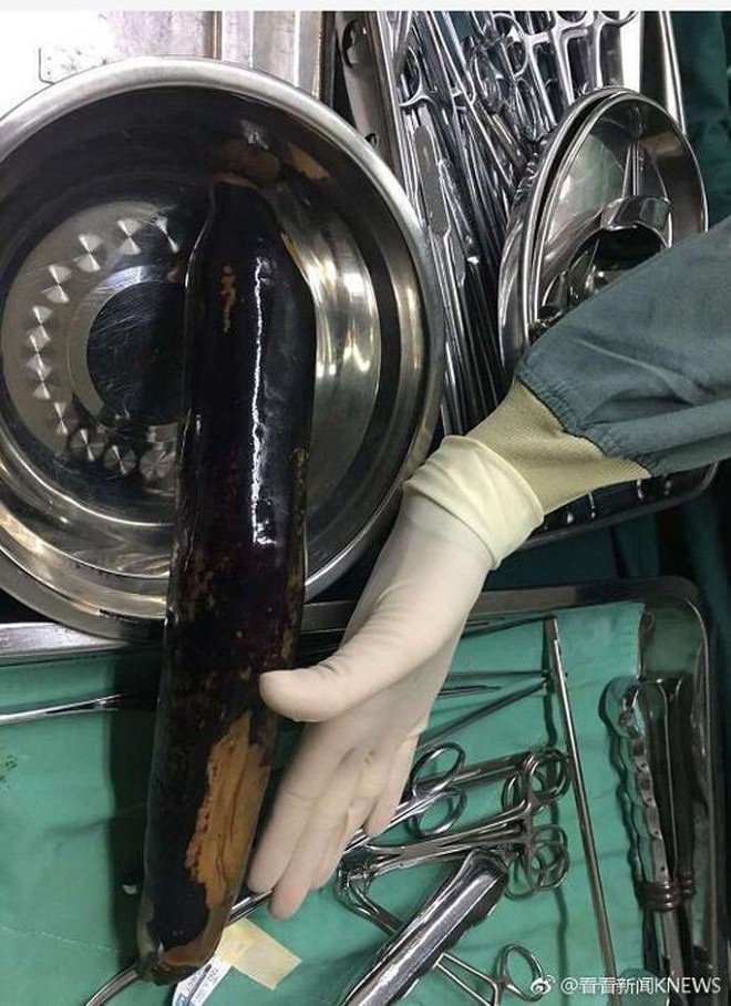 Trung Quốc: Tới bệnh viện với quả cà tím trong trực tràng, người đàn ông khai "để chữa táo bón theo mẹo dân gian" - Ảnh 2.