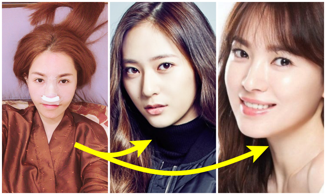 Từng m&ecirc; Krystal nay lại đổi sang Song Hye Kyo, Quế V&acirc;n hễ th&iacute;ch ai l&agrave; đi sửa mũi cho giống bằng được người ấy - Ảnh 3.