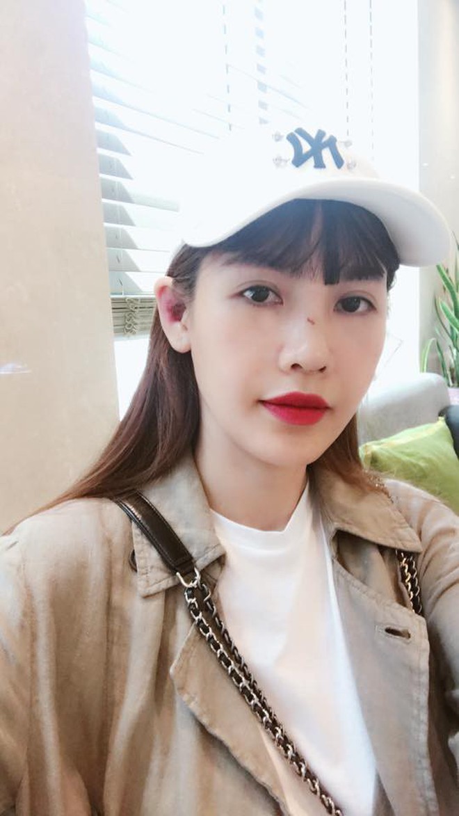 Cận cảnh gương mặt của Quế Vân sau cuộc phẫu thuật mũi lần thứ 6 - Ảnh 1.